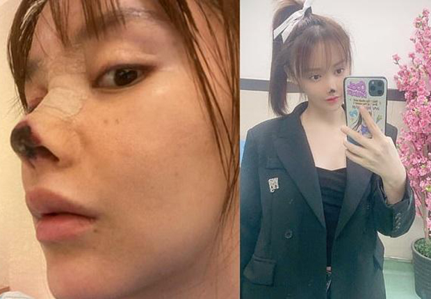 Una actriz pierde la nariz tras someterse a una cirugía estética. 
