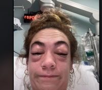 Inoportuna reacción alérgica tras una operación estética